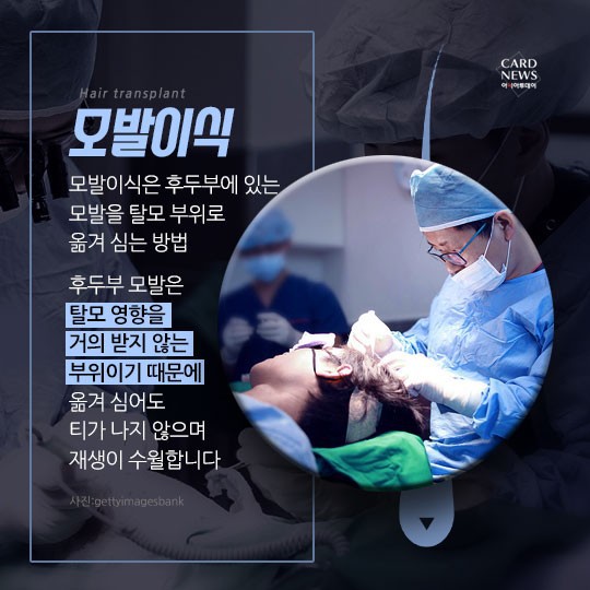 [카드뉴스] “소중한 머리카락 왜 자꾸 빠질까?”... 탈모 원인 및 치료법? 